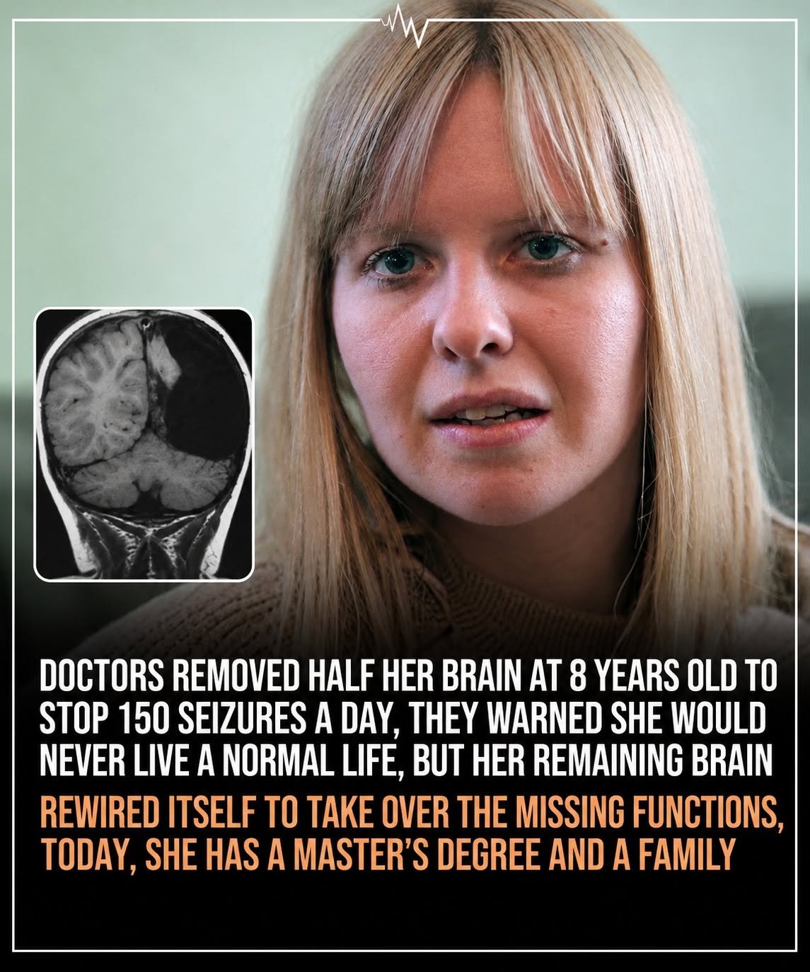 Doctors Removed Half of Her Brain at Age 8—What Christina Did Next Defied Expectations